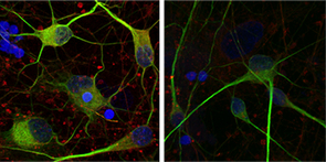 These human motor neurons have been immunostained to highlight the cell membrane and regions containing DNA and Hsc70/HSPA8 in green, blue and red, respectively. Right: Normal human motor neurons. Hsc70/HSPA8 also lines the membranes of these cells, tinting them yellow as the red immunostain is layered with green. Left: Human motor neuron derived from ALS patient. (Image: Rita Sattler/Barrow Neurological Institute) These human motor neurons have been immunostained to highlight the cell membrane and regions containing DNA and Hsc70/HSPA8 in green, blue and red, respectively. Right: Normal human motor neurons. Hsc70/HSPA8 also lines the membranes of these cells, tinting them yellow as the red immunostain is layered with green. Left: Human motor neuron derived from ALS patient. (Image: Rita Sattler/Barrow Neurological Institute)